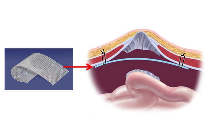 Герниопластика сеткой: надёжное решение для лечения грыж