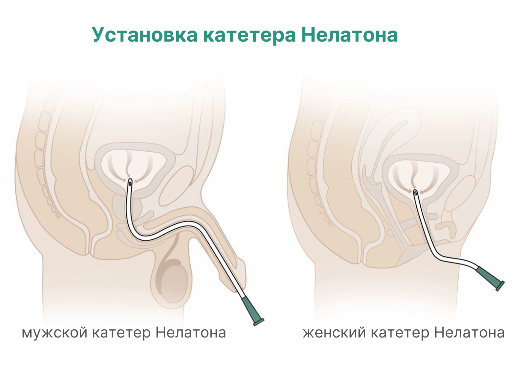 Техники успешной установки катетеров Нелатона