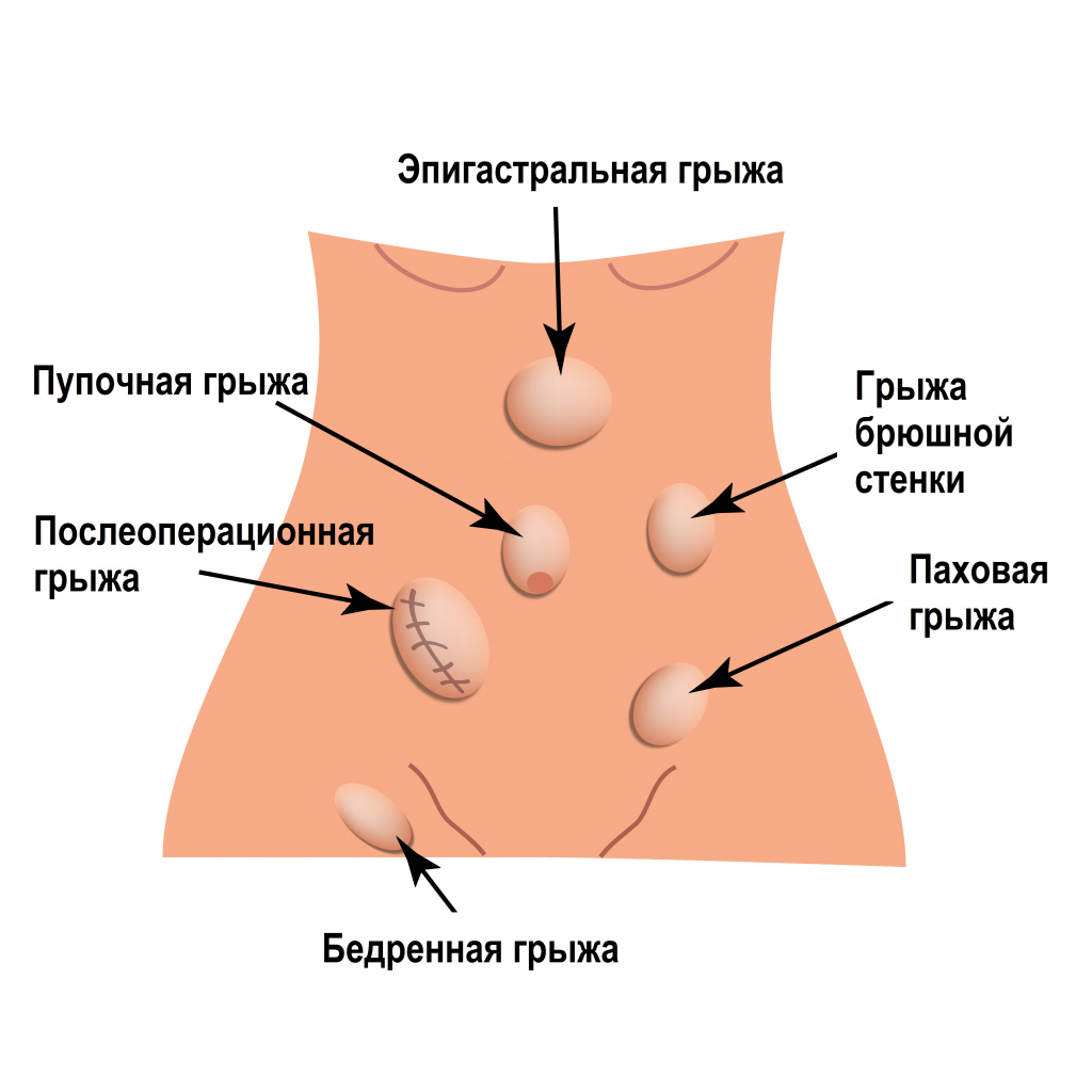 Откуда берутся грыжи и что с ними делать?