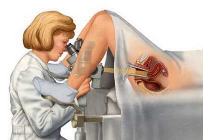 Когда проводится биопсия шейки матки?