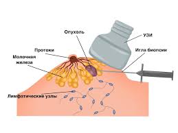 Трепанобиопсия молочной железы.jpeg